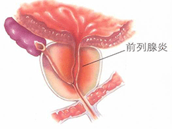 什么是前列腺炎?